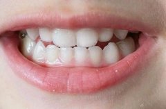 洛阳牙科医院儿童牙科收费贵吗？奶瓶龋、儿童龋齿部分有折扣 